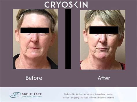 Checkout Our Before And After Cryoskin Face Results