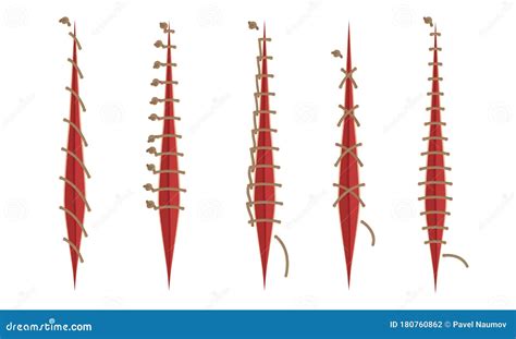 Surgical Stitches Infographic Set Royalty Free Vector