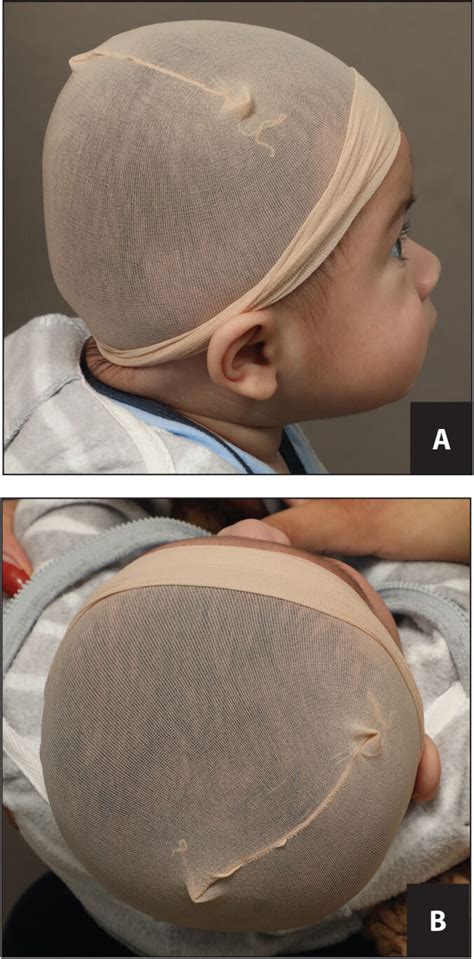 Positional Plagiocephaly And Craniosynostosis Pediatric Annals