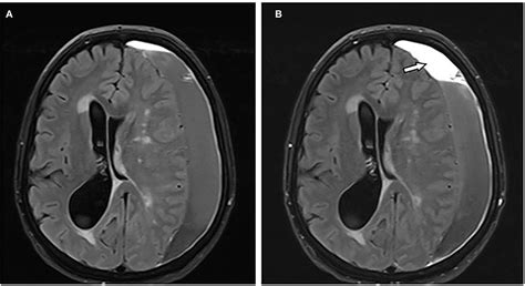 Frontiers Mri Appearance Of Chronic Subdural Hematoma