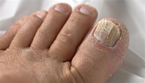 Onychomycosis Fungal Infection In The Nails Everything You Need To