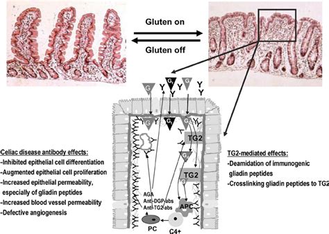 The Pathogenesis Of Celiac Disease In Celiac Disease Patients The