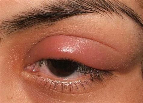 5 Reasons For Your Swollen Eyelid The Luxury Spot
