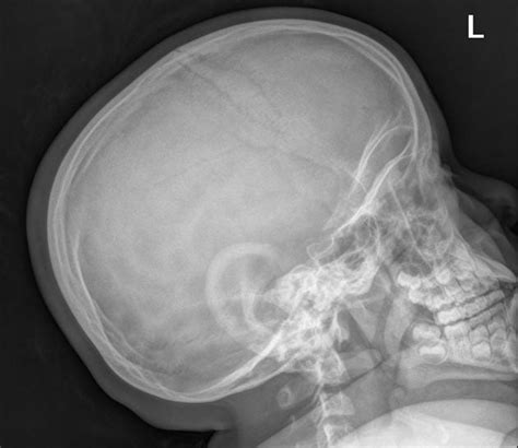 Achondroplasia Radiology Case