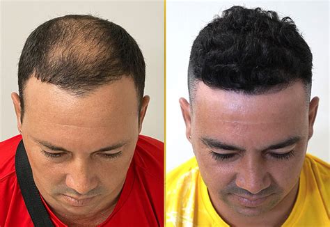 Neograft Hair Transplant Automated Fue Care Hair