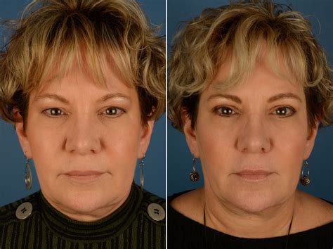 Blepharoplasty Photos Naples Fl Patient 25270