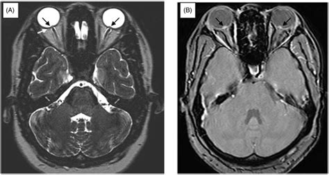 High Resolution T2 Weighted A And Gradient Recall Echo B Mri Scan