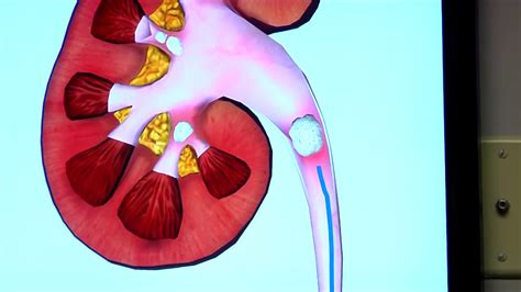 Ureteroscopy Procedure For Kidney Stones Youtube