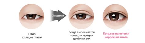 Коррекция птоза в Корее Пластика глаз хирургия 【id Hospital】