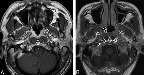A Axial T1 Weighted Postcontrast Mr Image Of The Nasopharynx In A