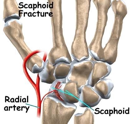 And there are other deep bones hidden deep beneath layers of muscle. Treatment for Fracture of Carpal Scaphoid in Singapore ...