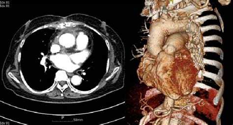The Postoperative Chest Ct Scan Shows The Ascending Aortic Graft