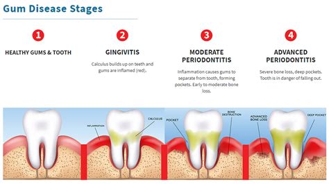 Why Are My Gums Bleeding Ascot Dental