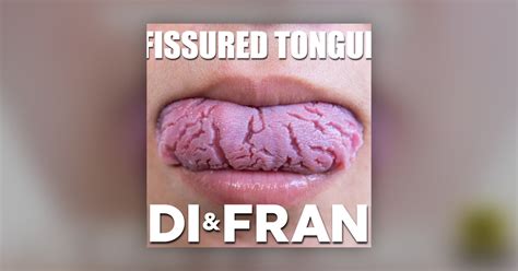 Fissured Tongues Heidi And Frank Morning Show Omnyfm