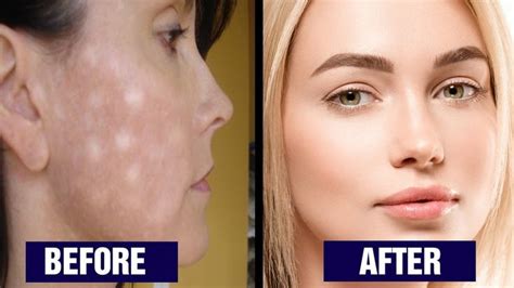 5 ways to get rid of white spots on face youtube spots on face white skin spots face treatment