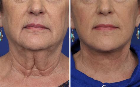 Facelift Before And After Photos Annapolis Non Surgical Facelift