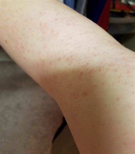 Skin Concern Acne Looking Bumps On My Upper Arms That Come And Go