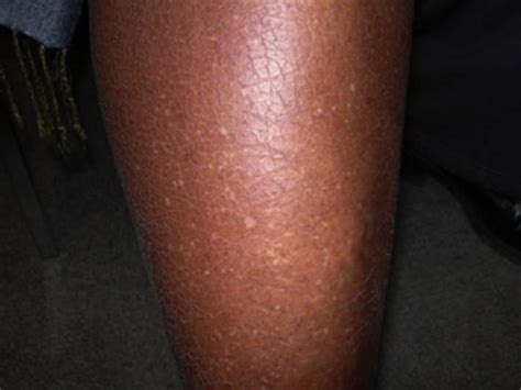 What Are Those White Spots On My Arms Idiopathic Guttate Hypomelanosis