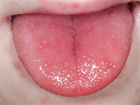Small Big Sore Red Spots On Tongue Cause And Meaning American Celiac