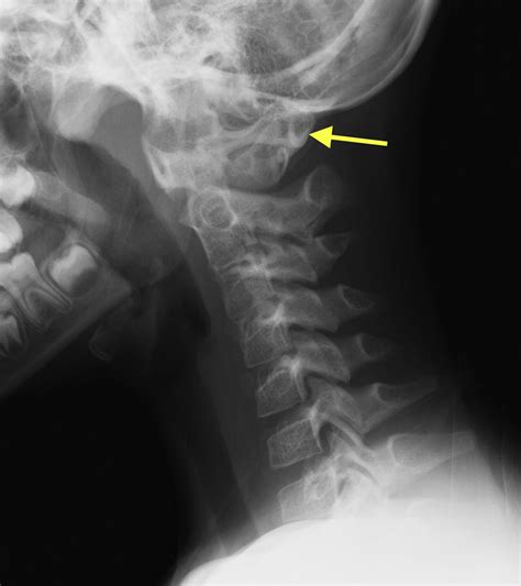 Child With Acute Neck Pain Annals Of Emergency Medicine