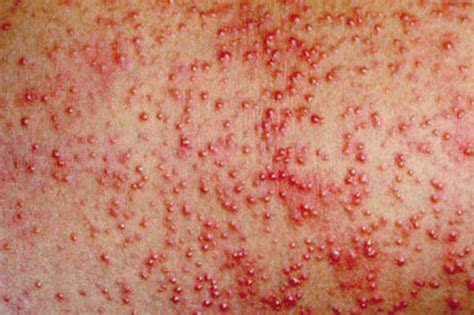 There are also many common skin rashes that can be caused due to infections or allergies. Skin Rashes in Children on Face in Adults on Hands on Arms ...
