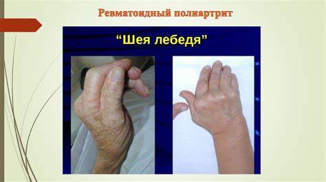 Ревматоидный полиартрит диета при полиартрите Сестринский уход при ревматоидном полиартрите - презентация онлайн Сестринский уход при ревматоидном полиартрите - презентация онлайн Ревматоидный полиартрит диета при полиартрите