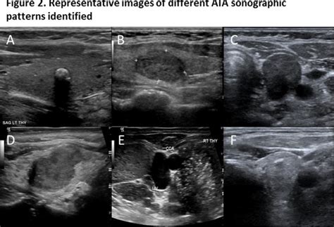 New American Thyroid Association Sonographic Patterns For Thyroid