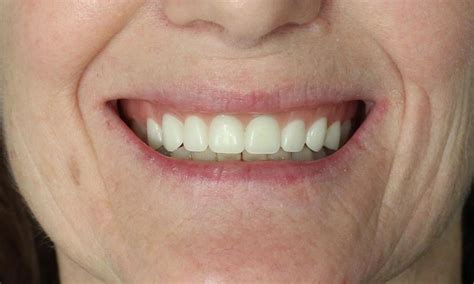 Smile Gallery Creating A Youthful Smile With Dentures Temple Tx