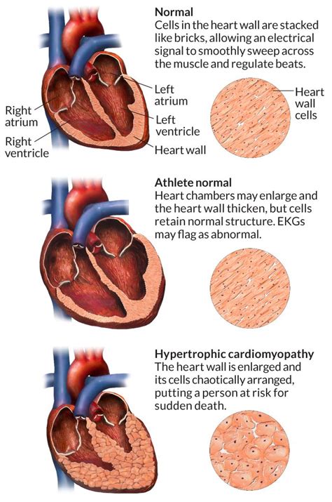 What Is The Life Expectancy Of Someone With Hypertrophic Cardiomyopathy