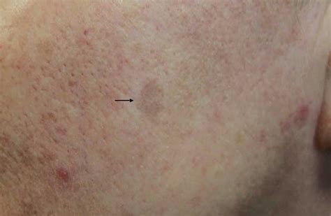 Lichenoid Keratosis Causes Symptoms Diagnosis And Treatment