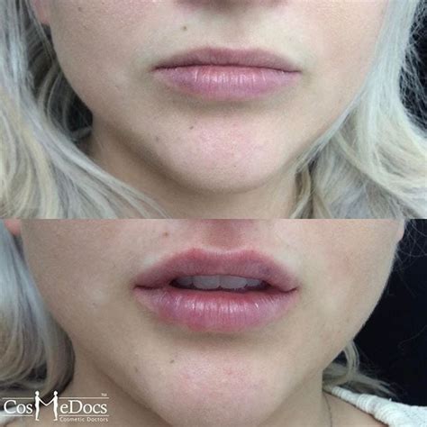 Lip Fillers With Dermal Filler Injections Harley Street London