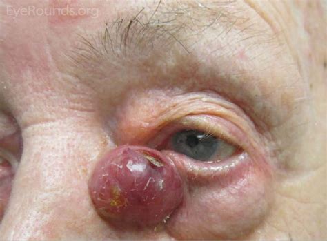 For merkel cell, surgical excision, sometimes sentinel lymph node biopsy for certain size tumors, radiation therapy and clinical trials may be. Merkel Cell Carcinoma