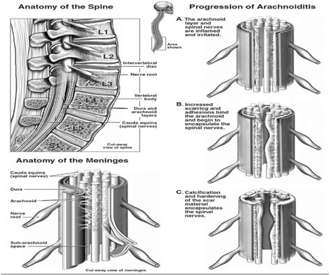 A Comprehensive Review Of Spinal Arachnoiditis Orthopaedic Nursing