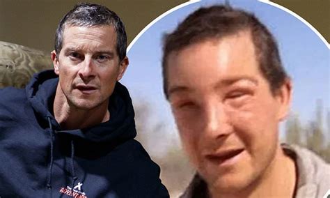 Bear Grylls Eye Swells Up After Bee Sting Leaves Him In Life Threatening Anaphylactic Shock