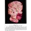 Pathology Outlines  Malignant Brenner Tumor