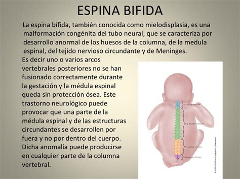 Espina Bifida