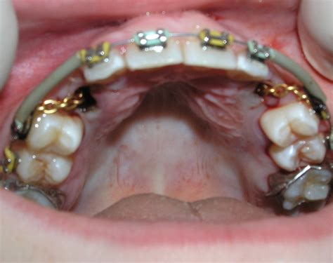 Gold Gold Chain Used For Impacted Tooth