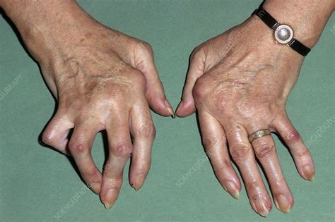 Rheumatoid Arthritis Of The Fingers Stock Image C0131057 Science