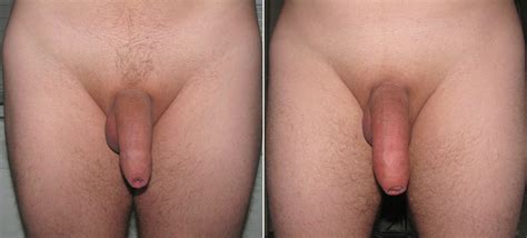 Penis Pump Before After Best Xxx Free Site Pic Comments