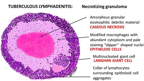 Tuberculous Lymphadenitis Pathology Made Simple