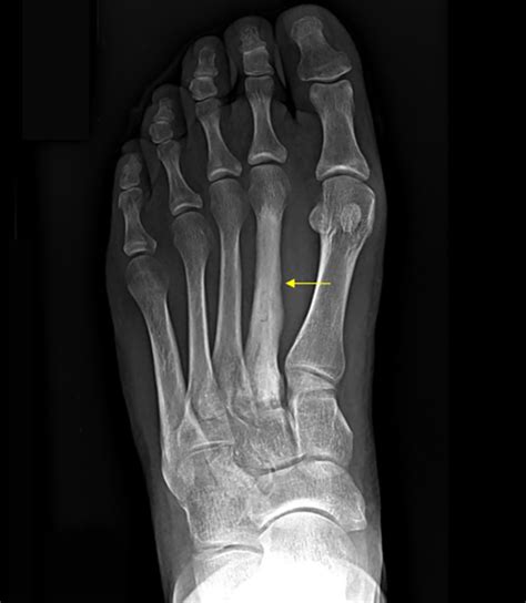 Metatarsal Fracture Left Foot