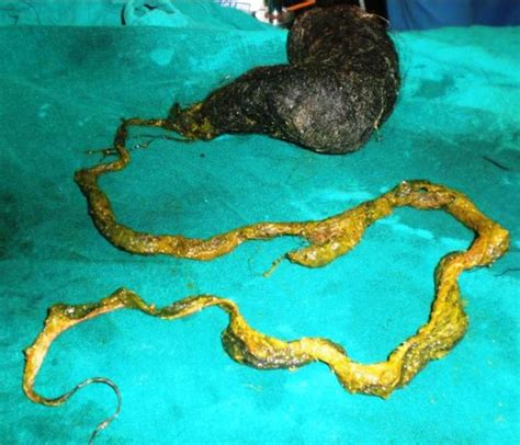 Doctors Remove Massive Metre Long Hairball From Girls Stomach After
