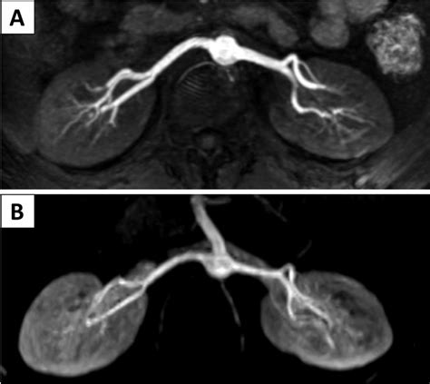 A Case Of 23 Years Old Male With Suspected Renal Artery Stenosis Mip