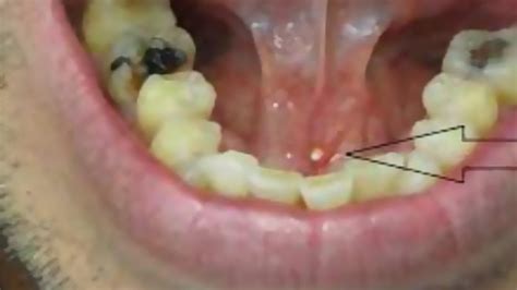 14 Salivary Stones Removed Sailolith Removal Youtube