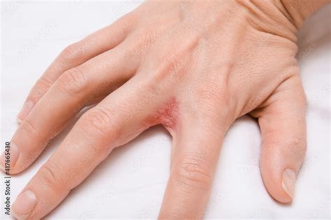 Hand With Interdigital Dermatitis Dyshidrotic Eczema On Hand Close Up