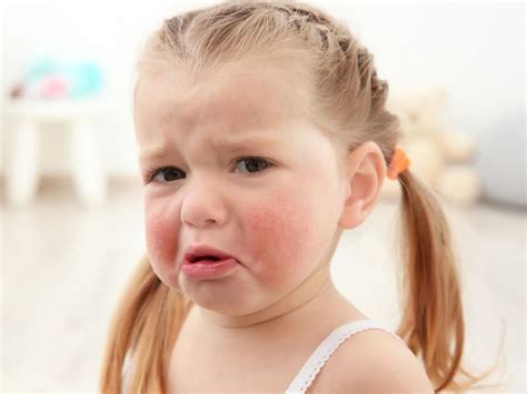 Allergic Reaction in Children: Treatment and Care - Origin Of Idea