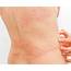 Urticaria Or Skin Rashes > Dr Health Clinic