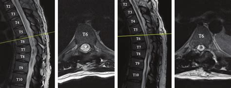 T2 Weighted Mri Of The Spine Pre Operative A Sagittal And B Axial