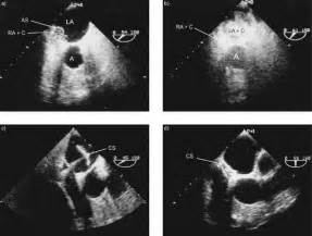 Patent Foramen Ovale Causing Position Dependent Shunting In A Patient