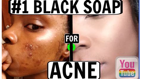 The 1 Best Black Soap For Acne Before And After Fair